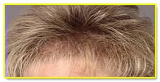 Hair Analysis Hair Analysis to your Health